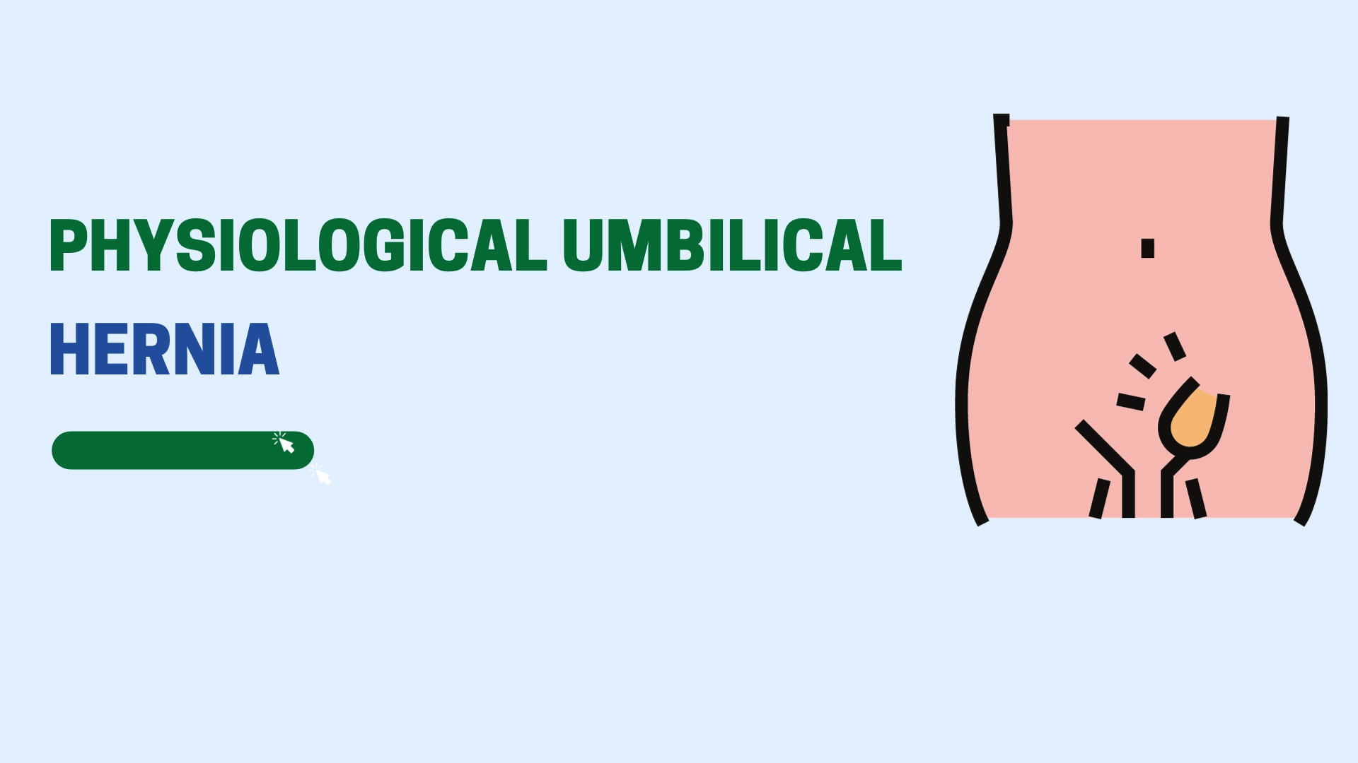 Physiological Umbilical Hernia
