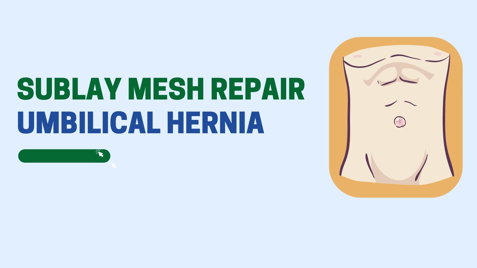 Sublay Mesh Repair Umbilical Hernia