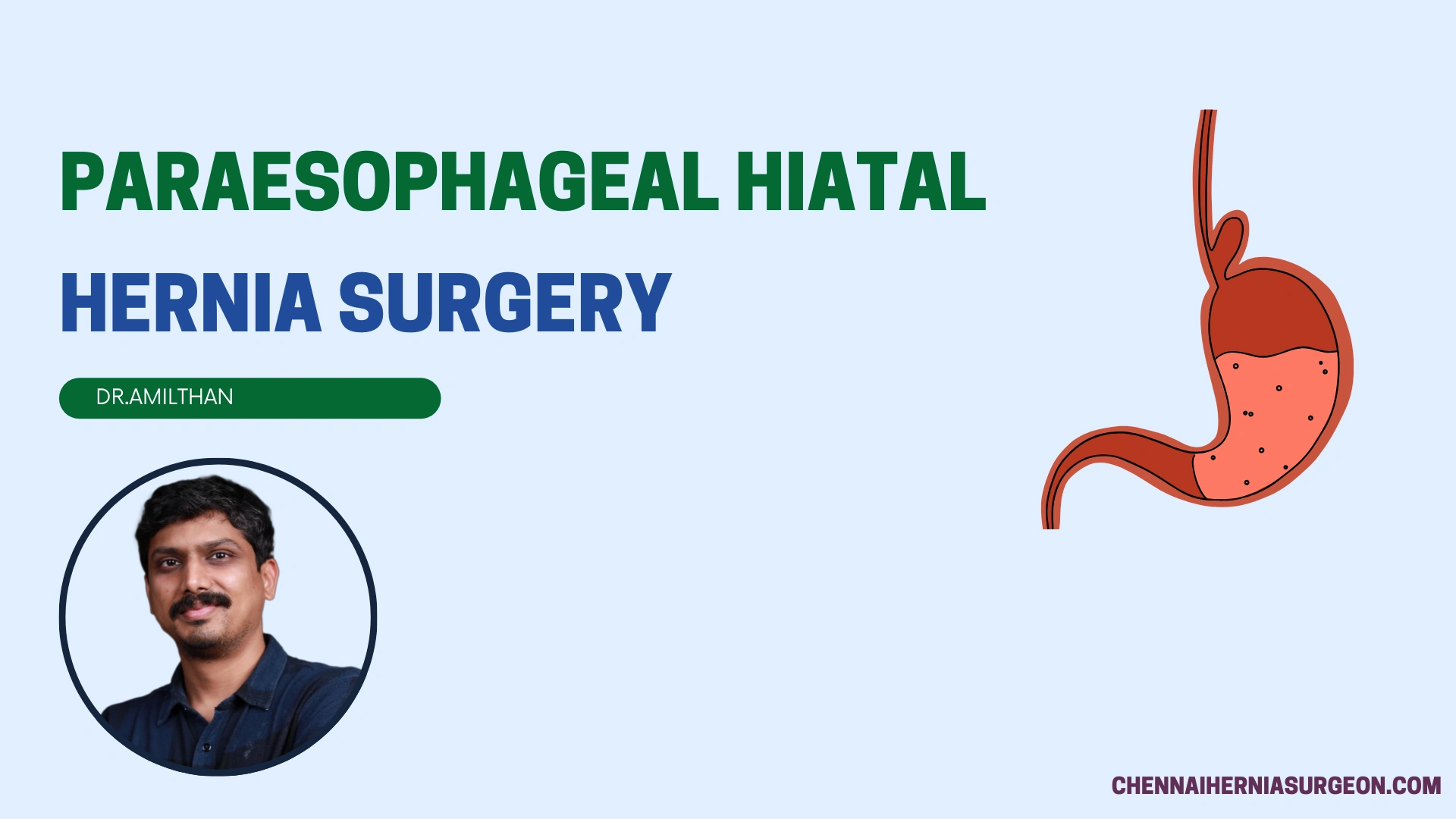 Paraesophageal Hiatal Hernia Surgery