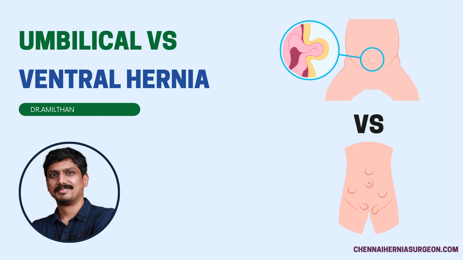 Umbilical vs Ventral hernia