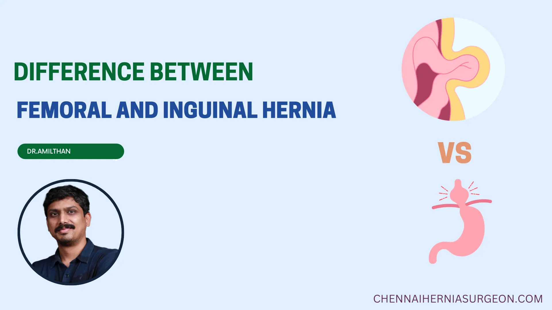 Difference Between Femoral and Inguinal Hernia