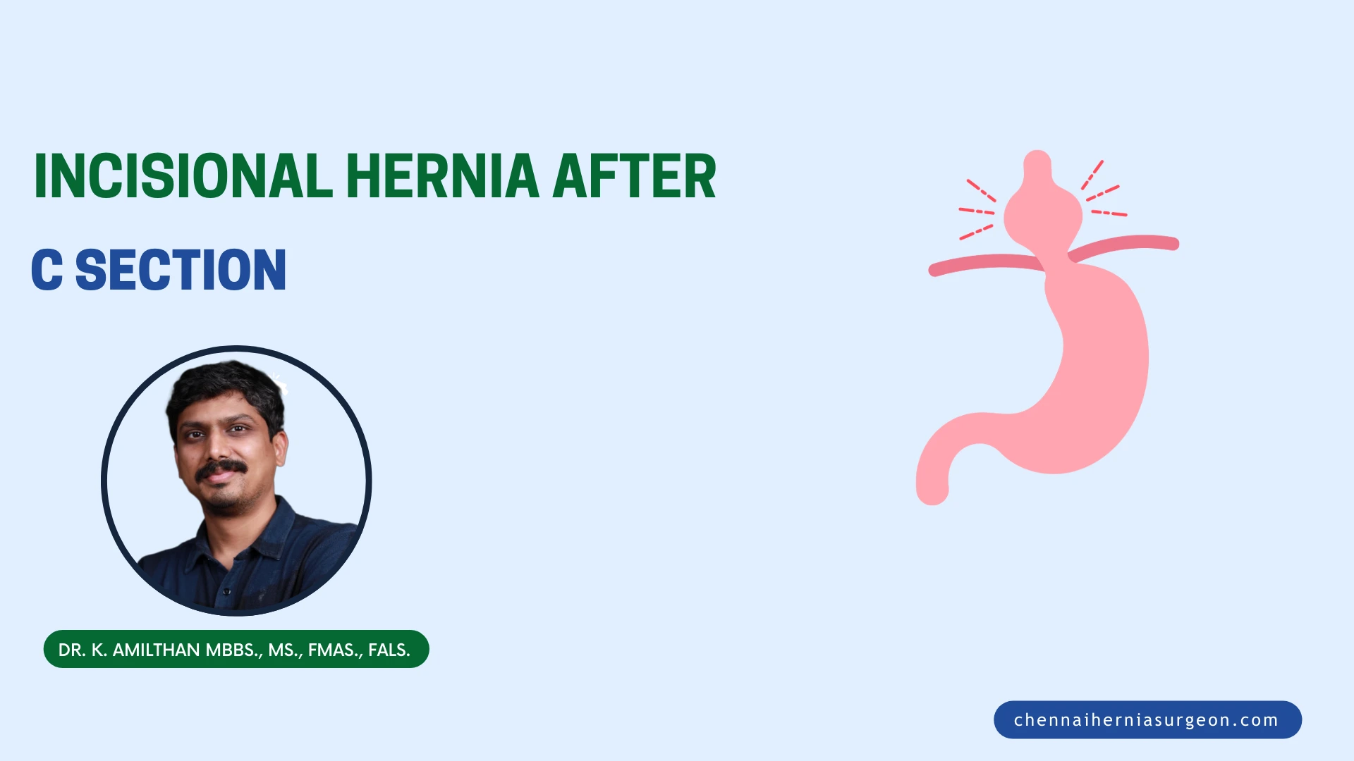 Incisional Hernia After C Section