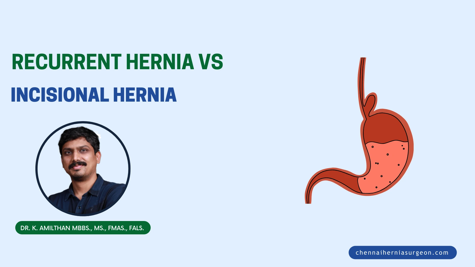 Recurrent Hernia Vs Incisional Hernia