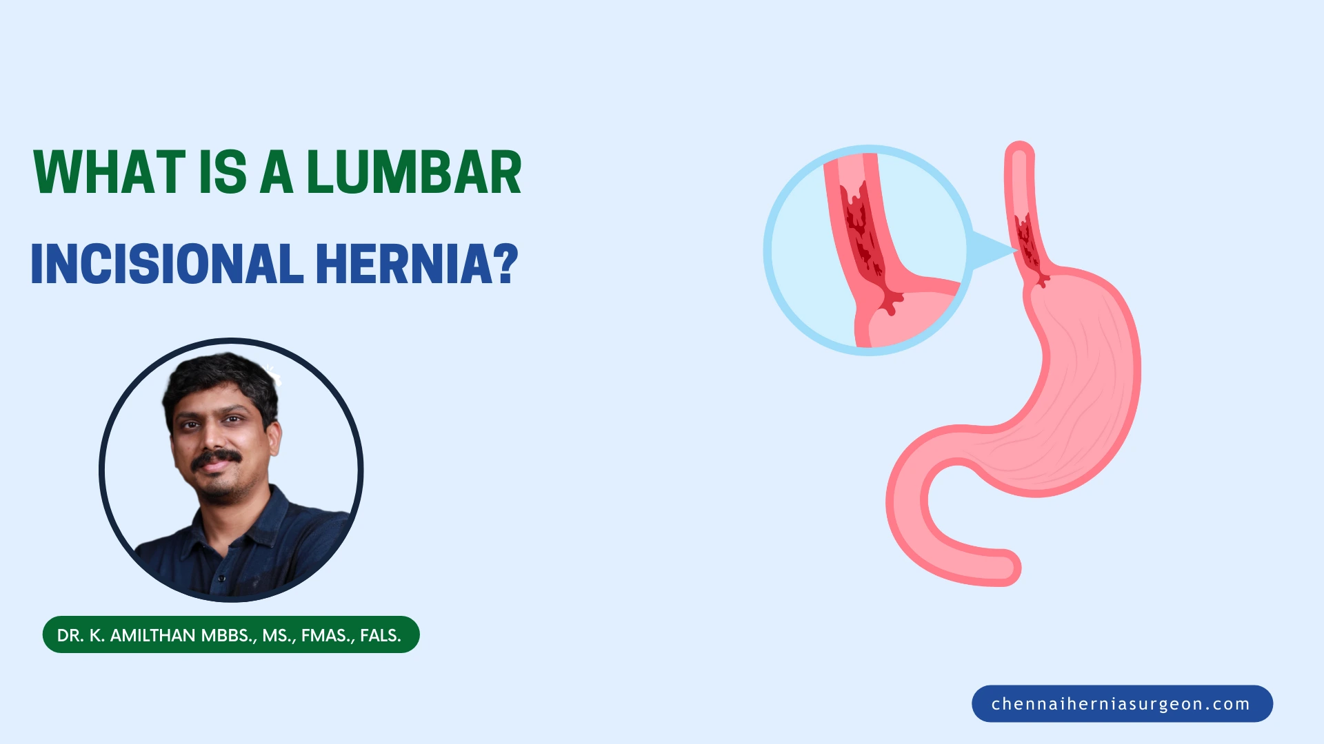 What is a lumbar incisional hernia