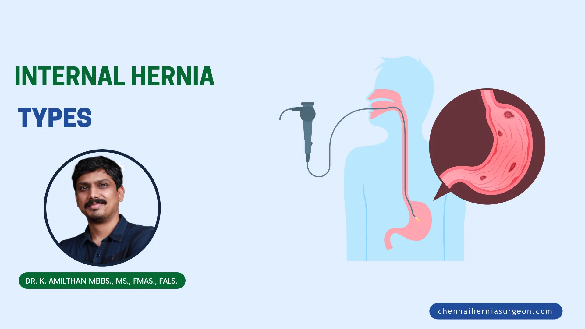 Internal Hernia Types