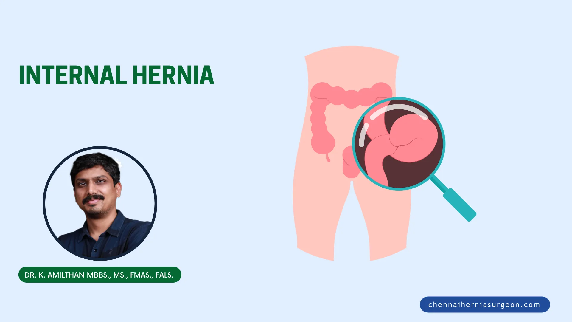 Internal Hernia