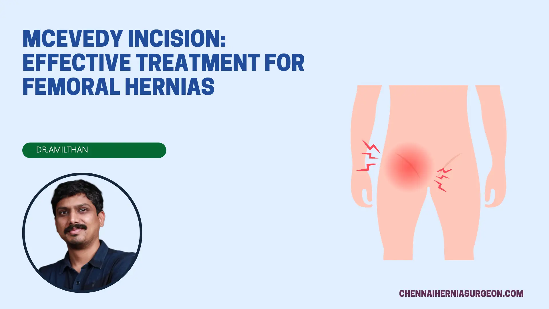 McEvedy Incision Effective Treatment for Femoral Hernias