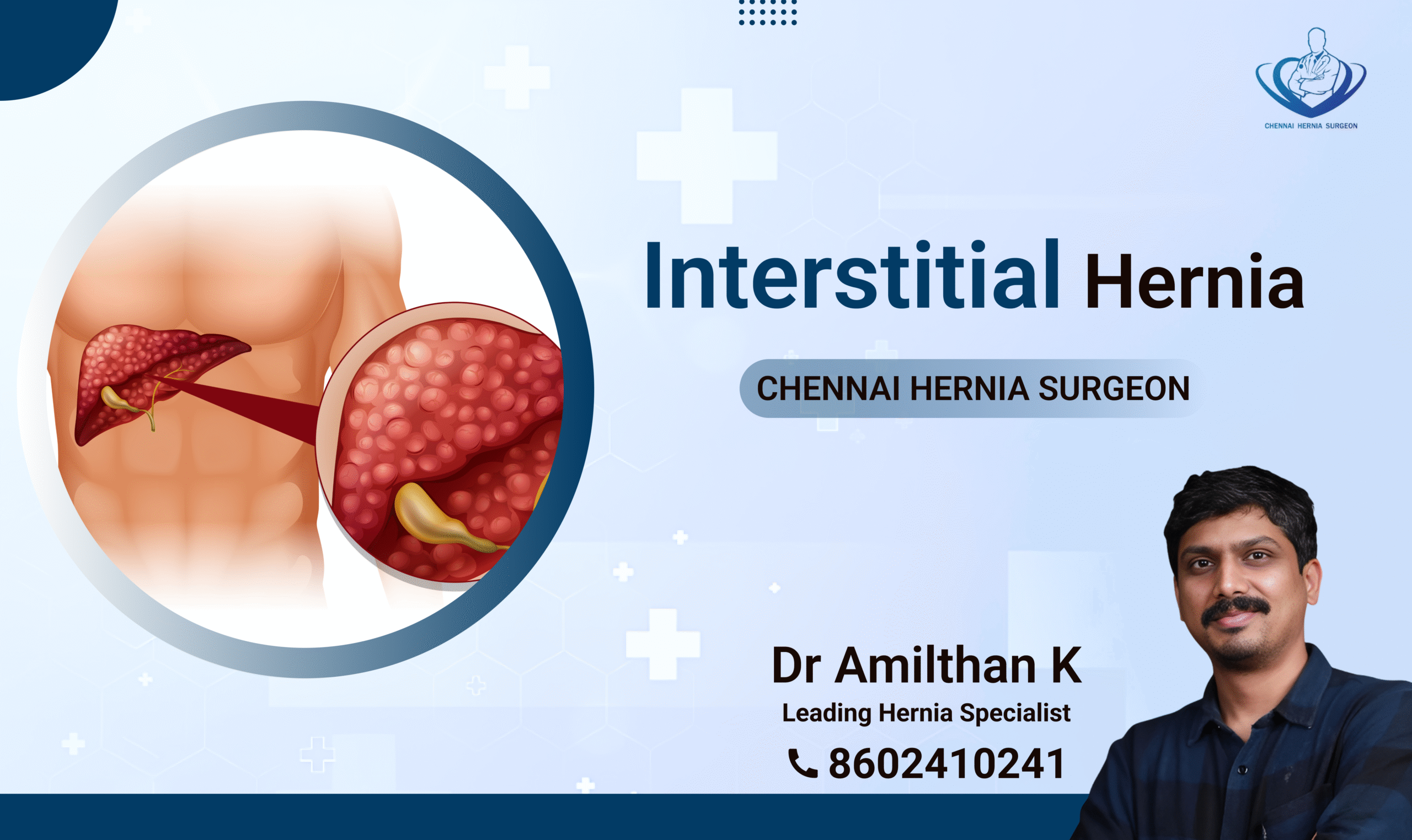 Interstitial Hernia