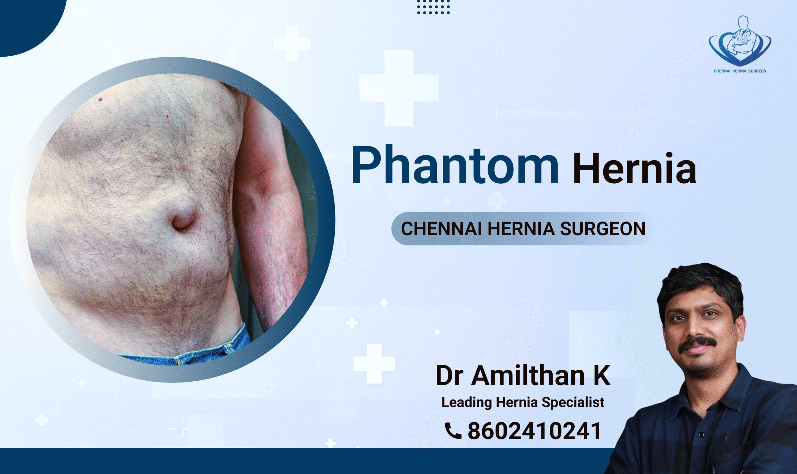 Phantom Hernia